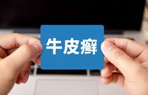 治疗牛皮癣的3个西药和3个中成药, 一文总结